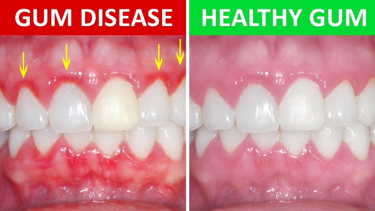 Gingivitis and Periodontitis: What Are the Differences?